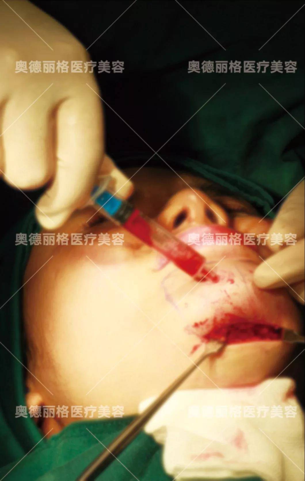 奥德丽格王志军解读奥美定取出手术后的8大"病患"疑虑