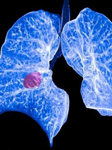 爱肺即是爱生命 ——这个世界肺癌日，让我们一起来关注肺部大富豪棋牌礼品码

