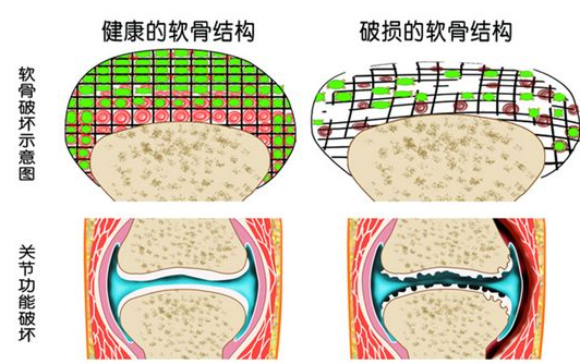 氨糖能够强烈的刺激软骨细胞合成人体的胶原蛋白和透明质酸,催生